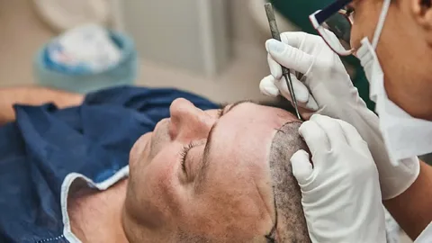 Beard Hair Transplant