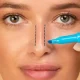 Rhinoplasty