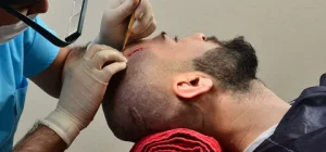 Hair Transplant