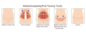 Tummy Tuck