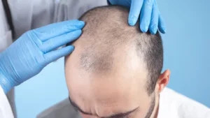 Hair Transplant Cost