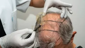 Hair transplant