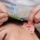 Otoplasty in Islamabad