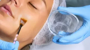 Chemical Peel