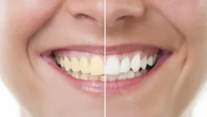Teeth Whitening
