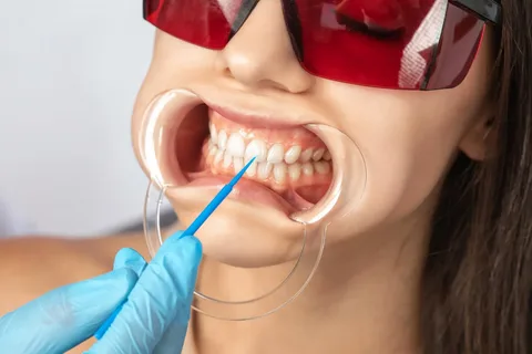 Teeth Whitening