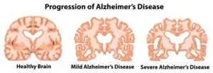 Alzheimer’s Disease