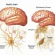 Alzheimer’s Disease