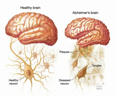 Alzheimer’s Disease