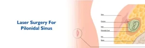 Pilonidal Sinus Treatment