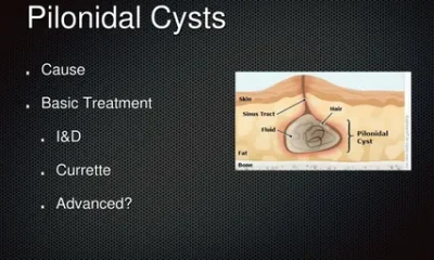 Pilonidal Sinus Treatment