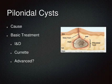Pilonidal Sinus Treatment