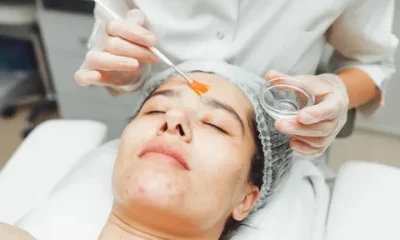 Chemical Peel