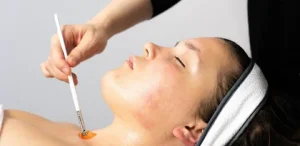 Chemical Peel