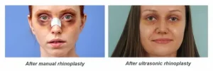 Ultrasonic Rhinoplasty