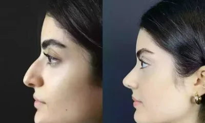Rhinoplasty in Dubai