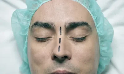 Rhinoplasty for Men