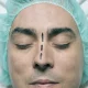 Rhinoplasty for Men