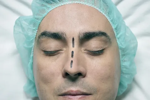 Rhinoplasty for Men