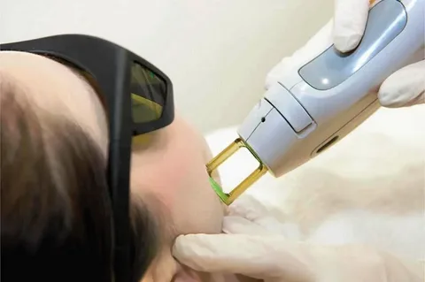 Laser Hair Removal