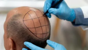 Hair Transplant Abu Dhabi