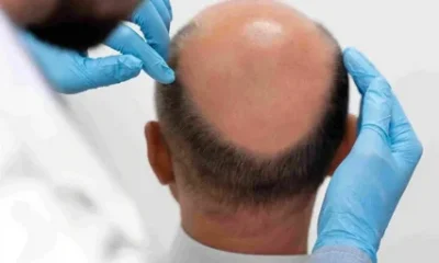 Hair Transplant in Dubai