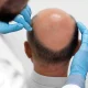 Hair Transplant in Dubai