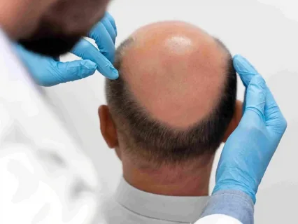 Hair Transplant in Dubai