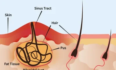 Pilonidal Sinus Treatment