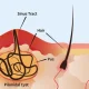 Pilonidal Sinus Treatment