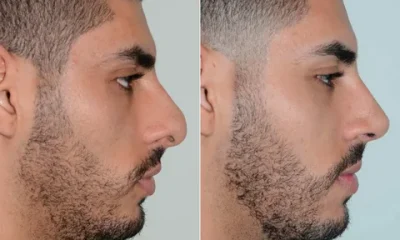 Male Rhinoplasty