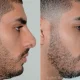 Male Rhinoplasty