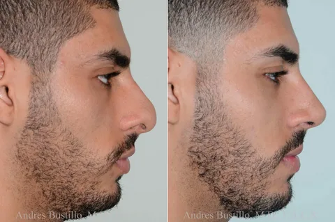 Male Rhinoplasty
