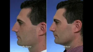 Male Rhinoplasty