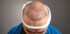 Hair Transplant