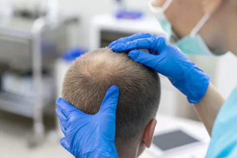 Hair Transplant