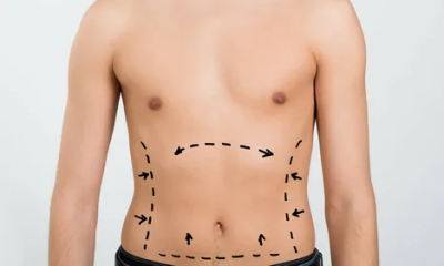 Liposculpture