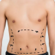 Liposculpture