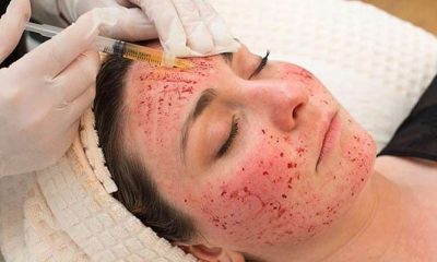 Vampire Facelift