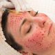 Vampire Facelift