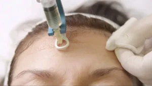 Mesotherapy Treatment