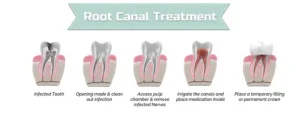 Root Canal Treatment RCT