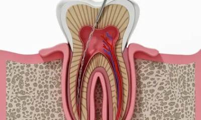 Root Canal Treatment RCT