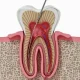 Root Canal Treatment RCT
