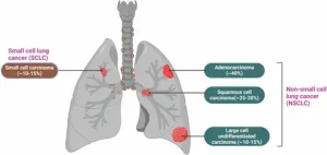 Lung Cancer