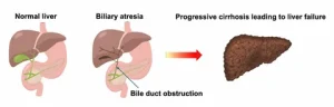 Biliary Tract