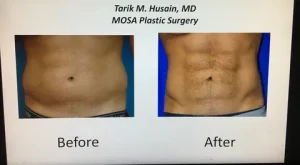 Six Pack Abs Surgery