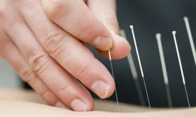 Acupuncture