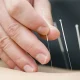 Acupuncture