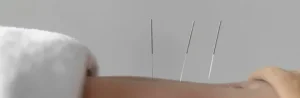 Acupuncture
